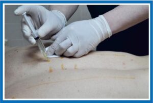 лечебная микро иньекционная терапия